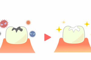 dental sealants treatment before after