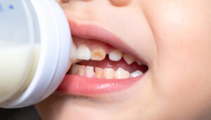 Illustration of baby bottle tooth decay in children, multiple cavities on front teeth.Generative AI